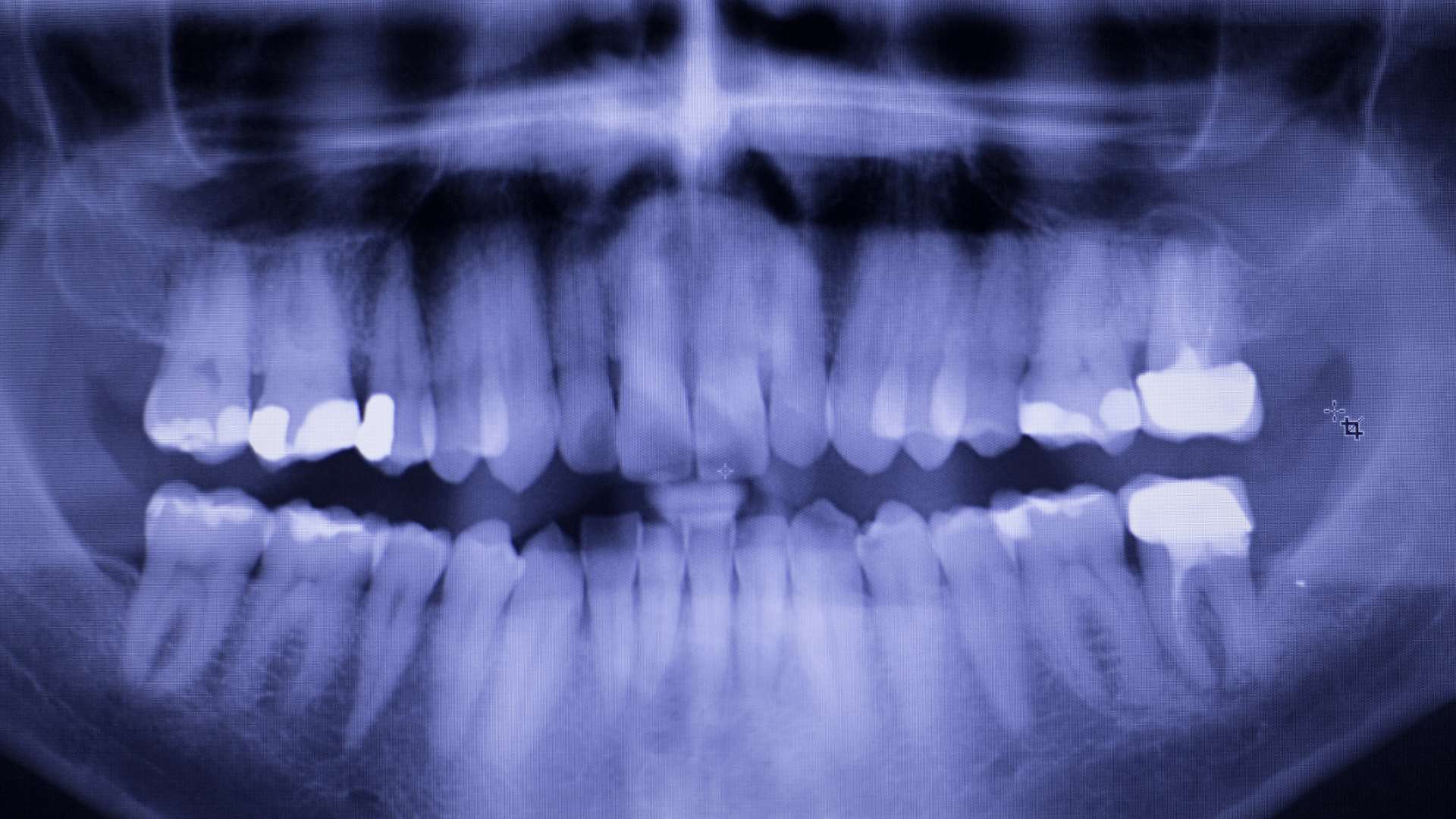 Bisphosphonate-Related Jaw Necrosis: Prevention Measures Before Implant Therapy